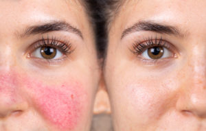 Laser Treatment for Rosacea | Rosacea Treatment Laser